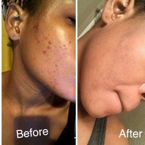Arbutin 7 Tranexamic Acid 4 Cream