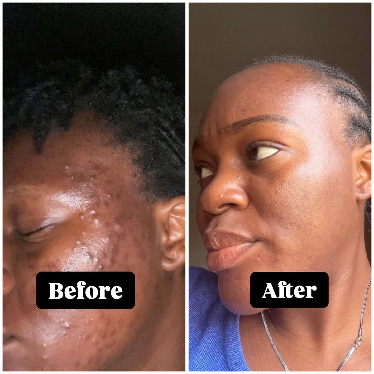 Arbutin 7 Tranexamic Acid 4 Cream